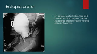 Ectopic ureter
 An ectopic ureter is identified and
inserted into the posterior urethra.
Associated grade III vesico-ureteric
reflux is also noted.
 