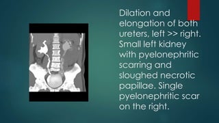 Dilation and
elongation of both
ureters, left >> right.
Small left kidney
with pyelonephritic
scarring and
sloughed necrotic
papillae. Single
pyelonephritic scar
on the right.
 