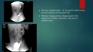  Primary megaureter - “A 10 month child came
for the workup of recurrent UTI.
 Primary megaureter is diagnosed in the
absence of reflux, stricture, calculus or
ureterocele.”
 