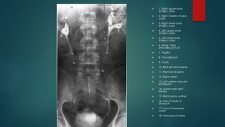  1. Right upper-pole
(major) calyx
 2. Right middle (major)
calyx
 3. Right lower-pole
(major) calyx
 4. Left upper-pole
(major) calyx
 5. Left lower-pole
(major) calyx
 6. Minor calyx
(infundibulum of)
 7. Papilla
 8. Infundibulum
 9. Fornix
 10. Bifid left renal pelvis
 11. Right renal pelvis
 12. Right ureter
 13. Left ureter: vascular
impression
 14. Upper pole right
kidney
 15. Right psoas outline
 16. Gas in body of
stomach
 17. Gas in transverse
colon
 18. Intravesical ureter
 