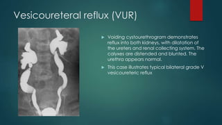 Vesicoureteral reflux (VUR)
 Voiding cystourethrogram demonstrates
reflux into both kidneys, with dilatation of
the ureters and renal collecting system. The
calyxes are distended and blunted. The
urethra appears normal.
 This case illustrates typical bilateral grade V
vesicoureteric reflux
 
