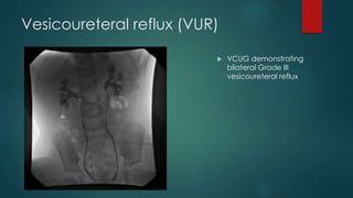 Vesicoureteral reflux (VUR)
 VCUG demonstrating
bilateral Grade III
vesicoureteral reflux
 
