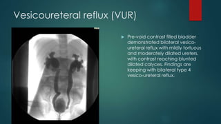 Vesicoureteral reflux (VUR)
 Pre-void contrast filled bladder
demonstrated bilateral vesico-
ureteral reflux with mildly tortuous
and moderately dilated ureters,
with contrast reaching blunted
dilated calyces. Findings are
keeping with bilateral type 4
vesico-ureteral reflux.
 