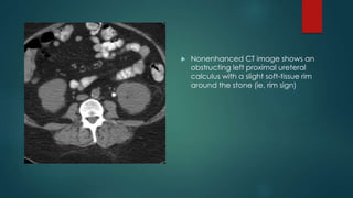 Nonenhanced CT image shows an
obstructing left proximal ureteral
calculus with a slight soft-tissue rim
around the stone (ie, rim sign)
 