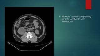  40 Male patient complaining
of right renal colic with
hematuria
 