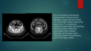  An oval shaped radiodense
stone is seen at the junction
between upper 2/3 and lower
1/3 of the right ureter measuring
about 0.5 x 1 cm along its
maximum diameters and eliciting
density of about (690 HU)
associated with marked
dilatation of the right pelvi-
calyceal system and proximal
part of the right ureter.
 