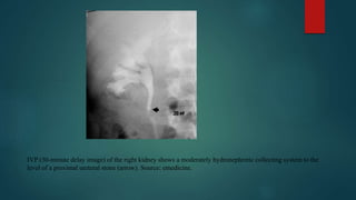 IVP (30-minute delay image) of the right kidney shows a moderately hydronephrotic collecting system to the
level of a proximal ureteral stone (arrow). Source: emedicine.
 