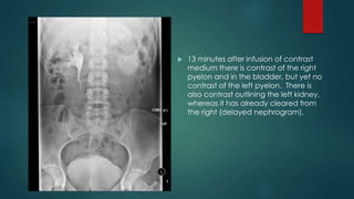  13 minutes after infusion of contrast
medium there is contrast of the right
pyelon and in the bladder, but yet no
contrast of the left pyelon. There is
also contrast outlining the left kidney,
whereas it has already cleared from
the right (delayed nephrogram).
 