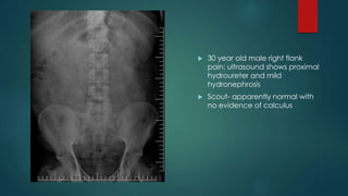  30 year old male right flank
pain; ultrasound shows proximal
hydroureter and mild
hydronephrosis
 Scout- apparently normal with
no evidence of calculus
 