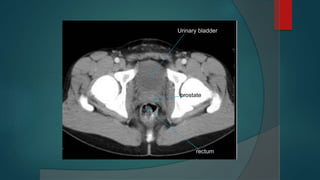 Urinary bladder
rectum
prostate
 
