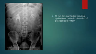  10 min film- right sided proximal
hydroureter and mild dilatation of
pelvicalyceal system
 