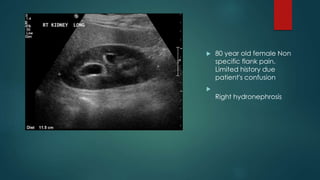  80 year old female Non
specific flank pain.
Limited history due
patient's confusion

Right hydronephrosis
 