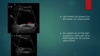  Left ureteric jet present (i.e.
left ureter non obstructed)
 No ureteric jet on the right
(suspicious, although not in
itself diagnostic for ureteric
obstruction)
 