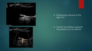  Shadowing calculus at the
right VUJ
 Comet tail artefact supports
the presence of a calculus
 