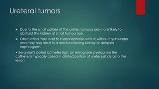 Ureteral tumors
 Due to the small caliber of the ureter, tumours are more likely to
obstruct the kidney at small tumour size.
 Obstruction may lead to hyrdonephrosis with or without hydroureter
and may also result in a non-functioning kidney or delayed
nephrogram.
• Bergman's coiled catheter sign: on retrograde pyelogram the
catheter is typically coiled in dilated portion of ureter just distal to the
lesion
 