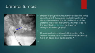 Ureteral tumors
 Smaller or polypoid tumours may be seen as filling
defects, and if they cause partial long-standing
obstruction may result in focal dilatation of the
ureter at the site of the tumour. This may lead to
the so-called goblet sign, best seen on
retrograde ureterography 2.

Occasionally circumferential thickening of the
ureteric wall results from diffuse infiltration an may
have an apple core appearance 4.

 