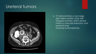 Ureteral tumors
 CT demonstrates a very large
right sided ureteric mass with
trapped contrast, which almost
mimics a vascular aneurysm, and
proximal long
standing hydronephrosis.
 