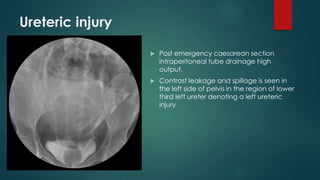 Ureteric injury
 Post emergency caesarean section
intraperitoneal tube drainage high
output.
 Contrast leakage and spillage is seen in
the left side of pelvis in the region of lower
third left ureter denoting a left ureteric
injury
 