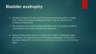Bladder exstrophy
 Imaging findings include a soft-tissue mass extending from a large
infra-umbilical anterior wall defect which may be close to the
umbilical arterial exits.
 The absence of a normal urinary bladder and a low-lying umbilical
cord insertion may also indicate the diagnosis.
 Failure of the pubic bones to meet in the midline (widened pubic
symphysis). This appearance on AP plain radiograph of the pelvis
has been likened to a manta ray swimming towards you (manta ray
sign).
 