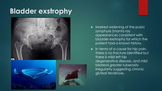 Bladder exstrophy
 Marked widening of the pubic
symphysis (manta ray
appearance) consistent with
bladder exstrophy for which the
patient had a known history.
 In terms of a cause for hip pain,
there is no fracture identified but
there is mild left hip
degenerative disease, and mild
bilateral greater tuberosity
irregularity suggesting chronic
gluteal tendinosis.
 