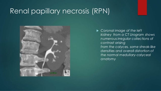 A study of renal papillary necrosis rpn