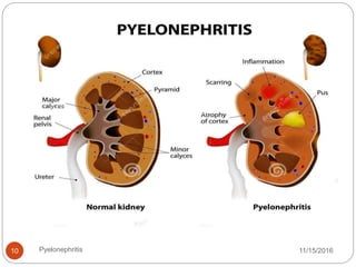 11/15/2016Pyelonephritis10
 