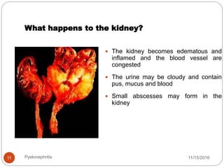 What happens to the kidney?
11/15/2016Pyelonephritis11
 The kidney becomes edematous and
inflamed and the blood vessel are
congested
 The urine may be cloudy and contain
pus, mucus and blood
 Small abscesses may form in the
kidney
 