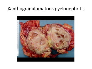Xanthogranulomatous pyelonephritis
 