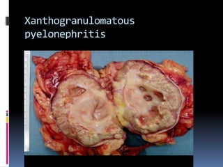 Xanthogranulomatous
pyelonephritis
 