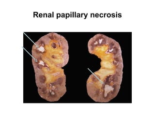 Renal papillary necrosis
 