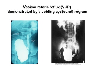 Vesicoureteric reflux (VUR)
demonstrated by a voiding cystourethrogram
 