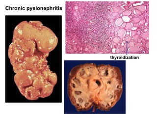 Chronic pyelonephritis
thyroidization
 