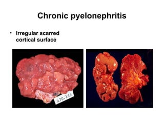 Chronic pyelonephritis
• Irregular scarred
cortical surface
 