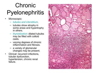Chronic
Pyelonephritis
• Microscopic:
– tubules and interstitium.
– tubules show atrophy in
some areas and hypertrophy
in others.
– thyroidization: dilated tubules
may be filled with colloid
casts.
– varying degrees of chronic
inflammation and fibrosis.
– a variety of glomerular
changes may be present.
• Clinical: recurrent infections,
tubular dysfunction,
hypertension, chronic renal
failure.
 