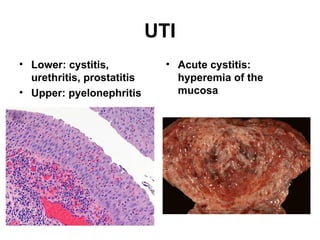 UTI
• Lower: cystitis,
urethritis, prostatitis
• Upper: pyelonephritis
• Acute cystitis:
hyperemia of the
mucosa
 