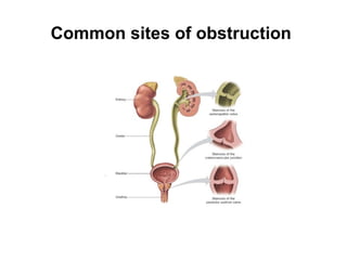Common sites of obstruction
 