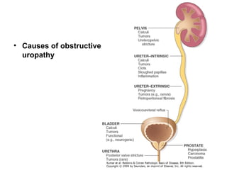 • Causes of obstructive
uropathy
 