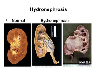 Hydronephrosis
• Normal Hydronephrosis
 