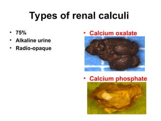 Types of renal calculi
• 75%
• Alkaline urine
• Radio-opaque
• Calcium oxalate
• Calcium phosphate
 
