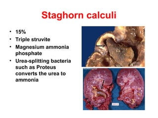 Staghorn calculi
• 15%
• Triple struvite
• Magnesium ammonia
phosphate
• Urea-splitting bacteria
such as Proteus
converts the urea to
ammonia
 