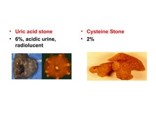 • Uric acid stone
• 6%, acidic urine,
radiolucent
• Cysteine Stone
• 2%
 