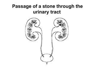Passage of a stone through the
urinary tract
 