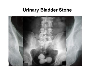 Urinary Bladder Stone
 