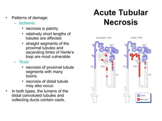 Acute Tubular
Necrosis
• Patterns of damage:
– Ischemic:
• necrosis is patchy
• relatively short lengths of
tubules are affected
• straight segments of the
proximal tubules and
ascending limbs of Henle’s
loop are most vulnerable
– Toxic:
• necrosis of proximal tubule
segments with many
toxins.
• necrosis of distal tubule
may also occur.
• In both types, the lumens of the
distal convoluted tubules and
collecting ducts contain casts.
 