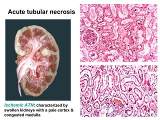 Ischemic ATN: characterized by
swollen kidneys with a pale cortex &
congested medulla
Acute tubular necrosis
 