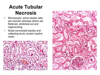Acute Tubular
Necrosis
• Microscopic: some tubular cells
are necrotic whereas others are
flattened, stretched out and
regenerating.
• Distal convoluted tubules and
collecting ducts contain hyaline
casts.
 