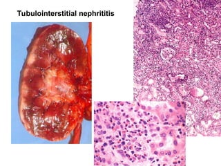 Tubulointerstitial nephrititis
 