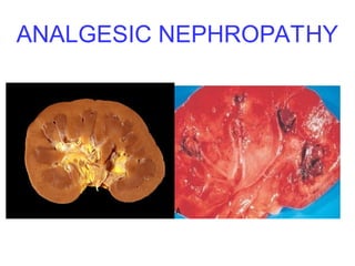 ANALGESIC NEPHROPATHY
 