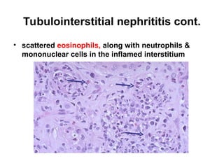 Tubulointerstitial nephrititis cont.
• scattered eosinophils, along with neutrophils &
mononuclear cells in the inflamed interstitium
 