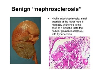 Benign “nephrosclerosis”
• Hyalin arteriolosclerosis: small
arteriole at the lower right is
markedly thickened in this
case of a diabetic (note the
nodular glomerulosclerosis)
with hypertension
 